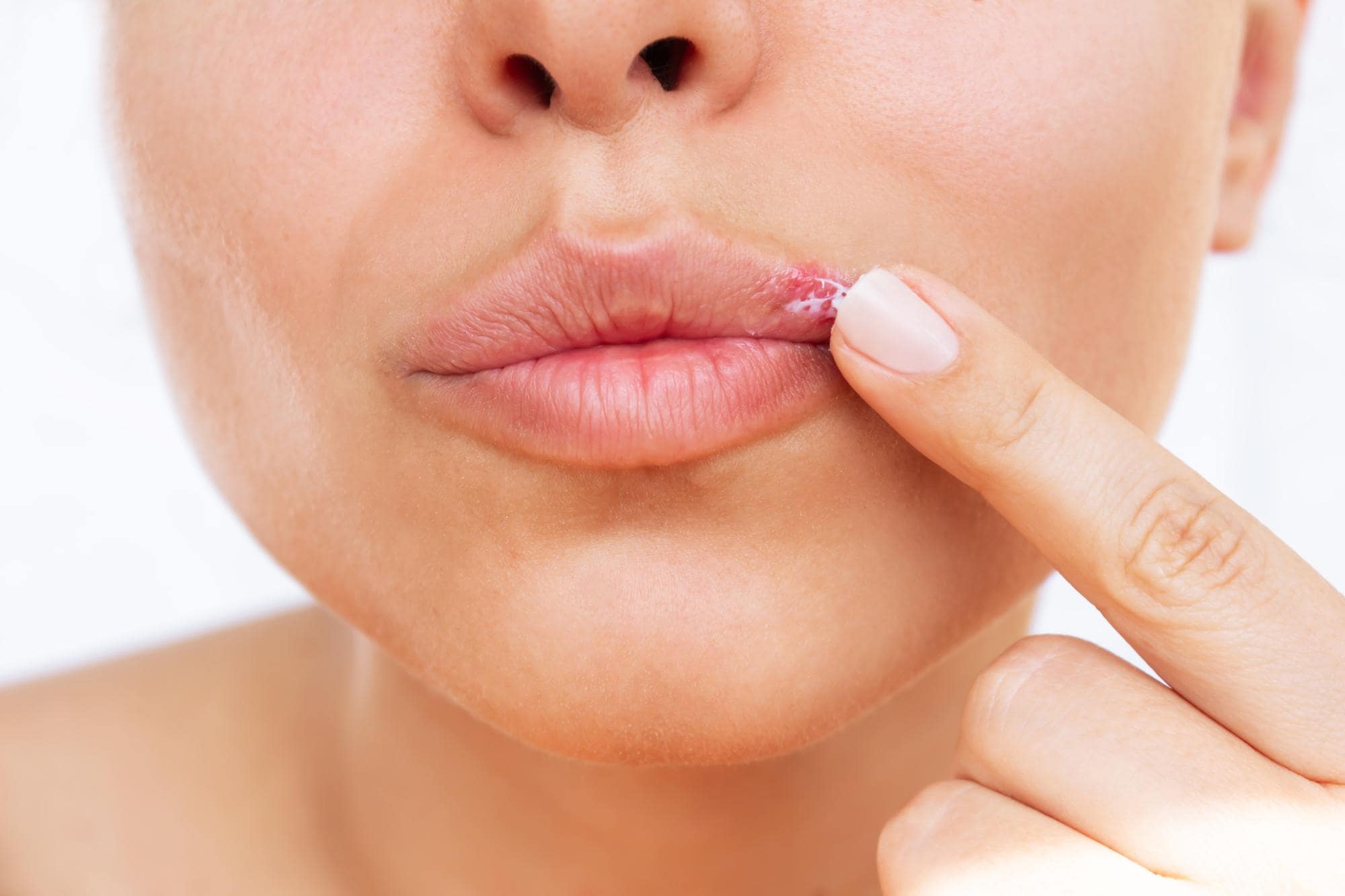 Лікування герпесу